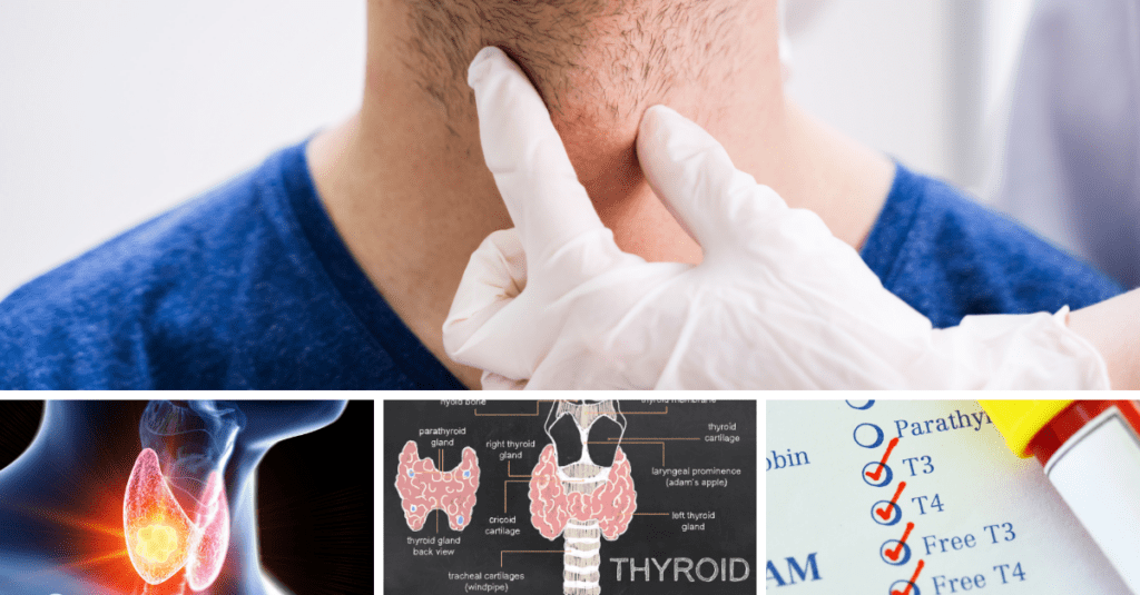 thyroid nodules - Hypothyroidism symptoms